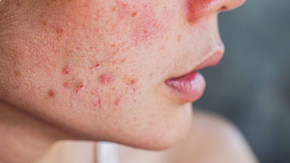 Cara Merawat Kulit Sensitif agar Terhindar dari Iritasi: 5 Tips yang Perlu Diperhatikan
